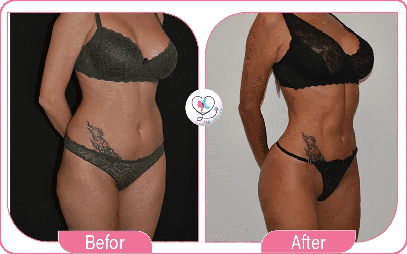 liposculpture avant après-4