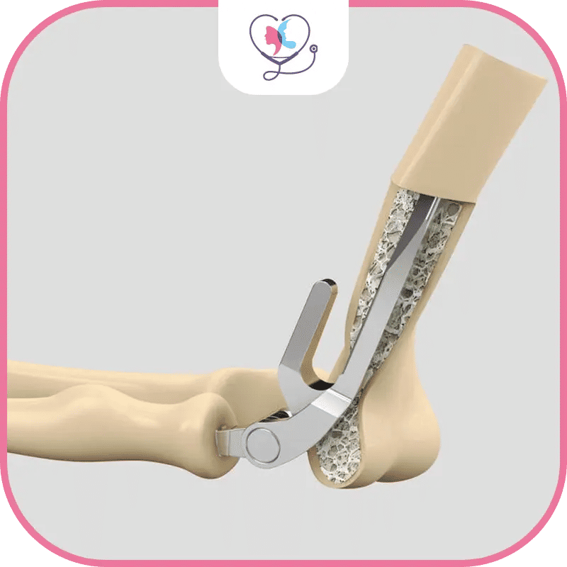 تكلفة استبدال مفصل الساعد في تركيا