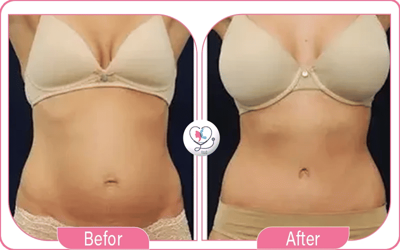 Tummy Tuck