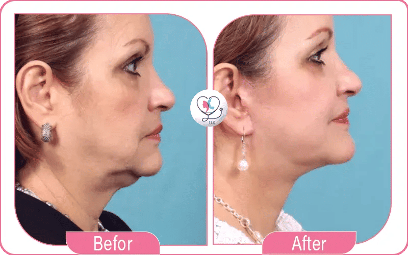 What to Expect from Non Surgical Neck Lift