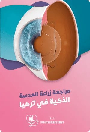 مراجعة زراعة العدسة الذكية في تركياfeatured image