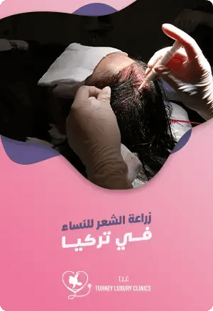 كيف تكون زراعة الشعر للنساء في تركيا؟featured image