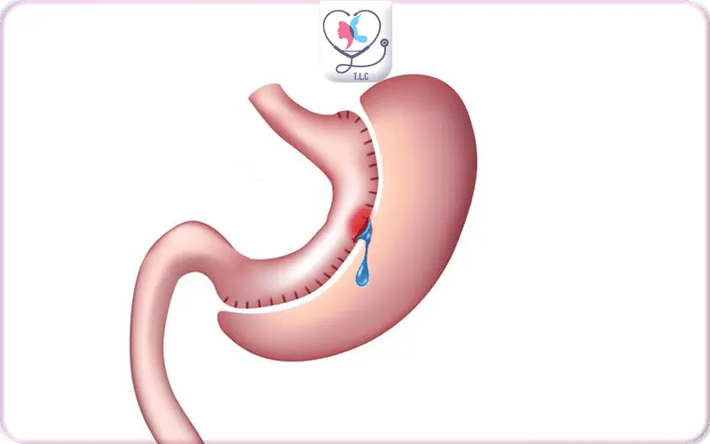 Qu’est-ce qu’une fistule après une sleeve ?