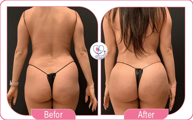 وداعاً للترهل بعد التكميم: تجربتي الناجحة مع تجميل المؤخرة