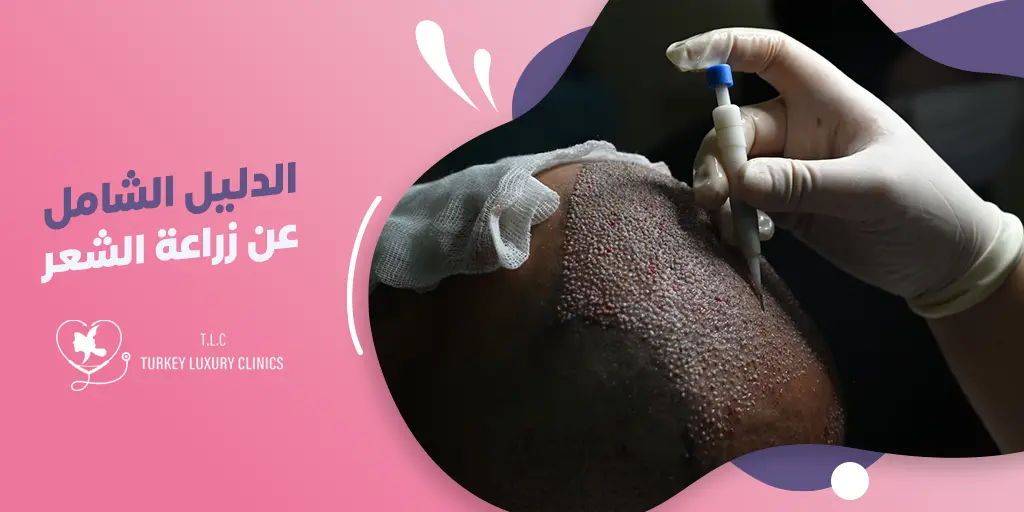 زراعة الشعر في تركيا: دليل شامل عن الأنواع والتقنيات والأسعار