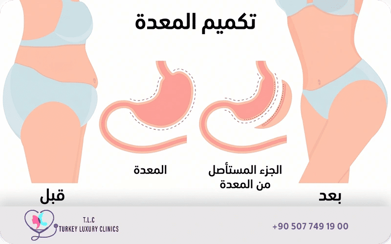ما هي عملية تكميم المعدة؟