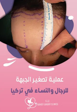 عملية تصغير الجبهة: الرجال والنساء والأسعار في تركيا