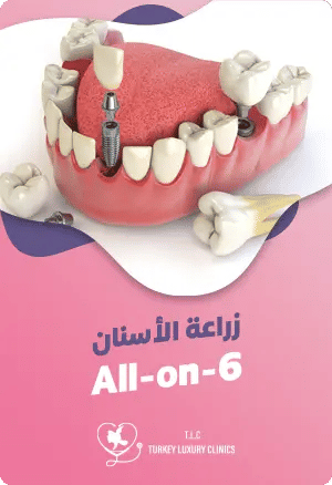 زراعة الأسنان All-on-6featured image
