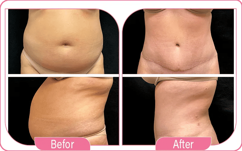 Qu’est-ce que l’abdominoplastie ?-2