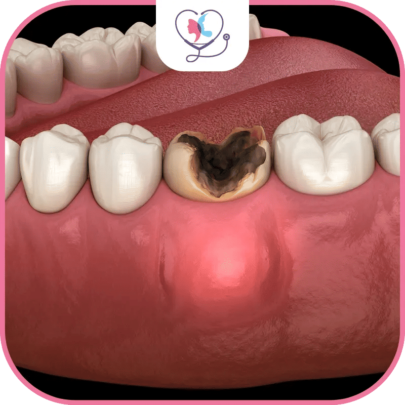 ما هو خراج الاسنان؟