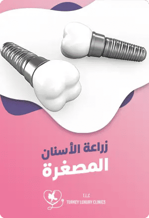 زراعة الأسنان المصغرةfeatured image