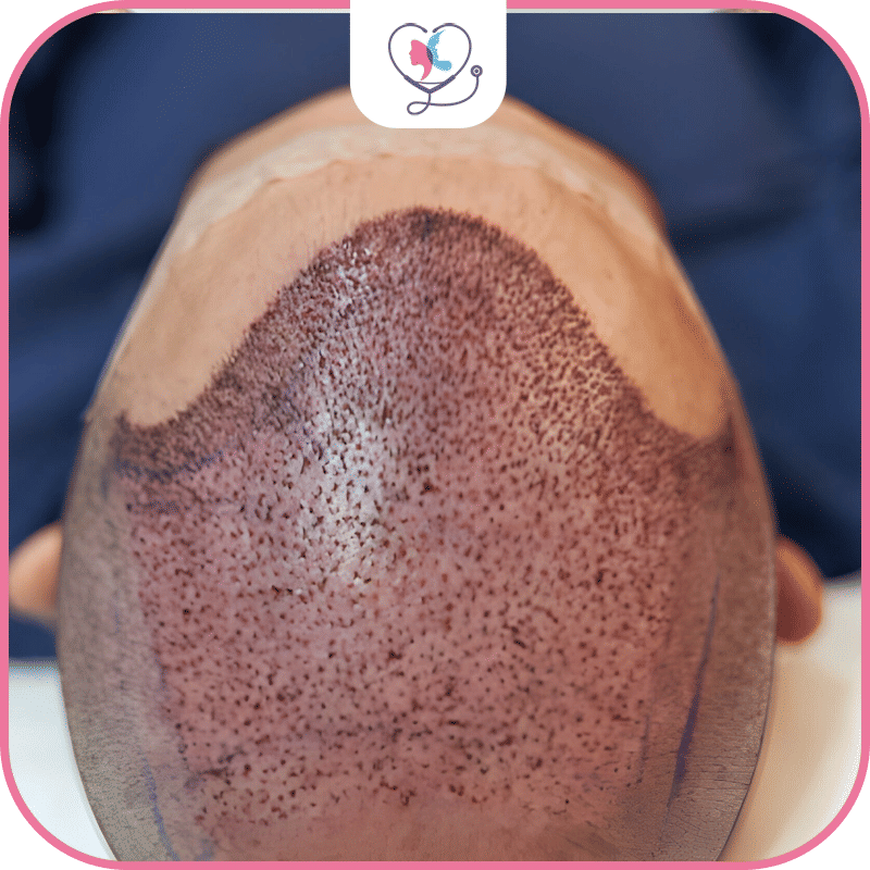 Hair Transplant Packages in Different Countries