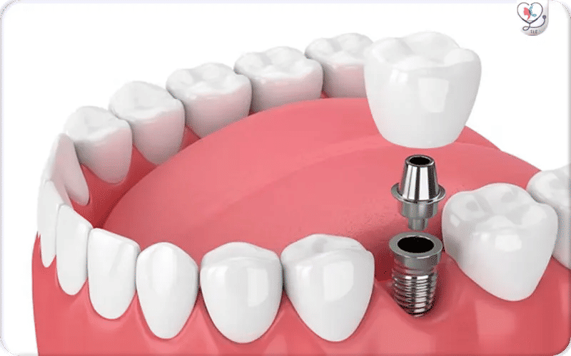 تأكد من نوع الغرسات المستخدمة
