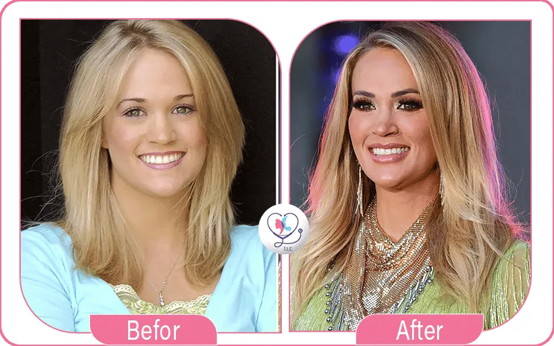Carrie Underwood Plastic Surgery Face