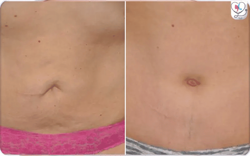 New Belly Button Opening Is Created After a Tummy Tuck