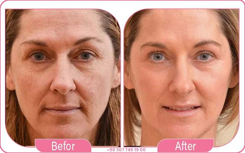 Best Hospitals for Deep Plane Facelift in Istanbul, Turkey