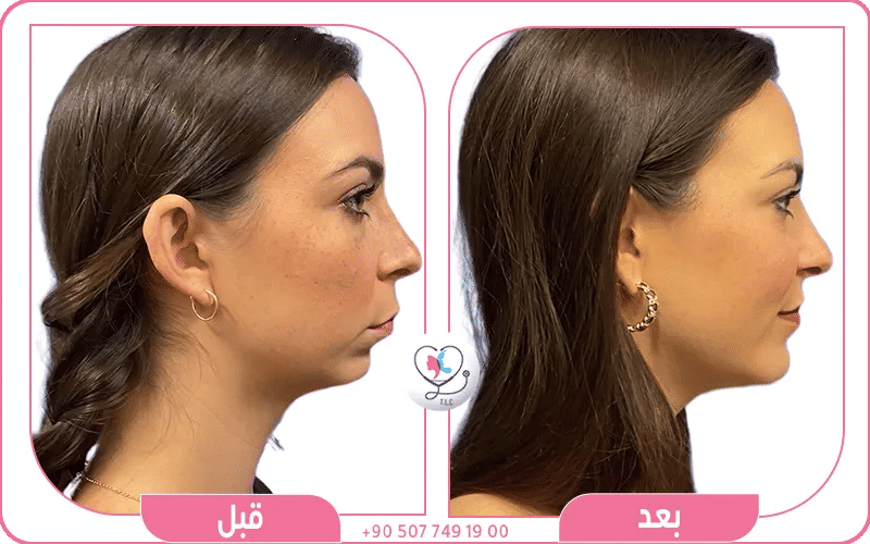 عملية تجميل الذقن للنساء