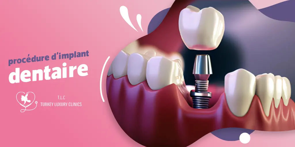 La procédure d'implant dentaire: étape par étape