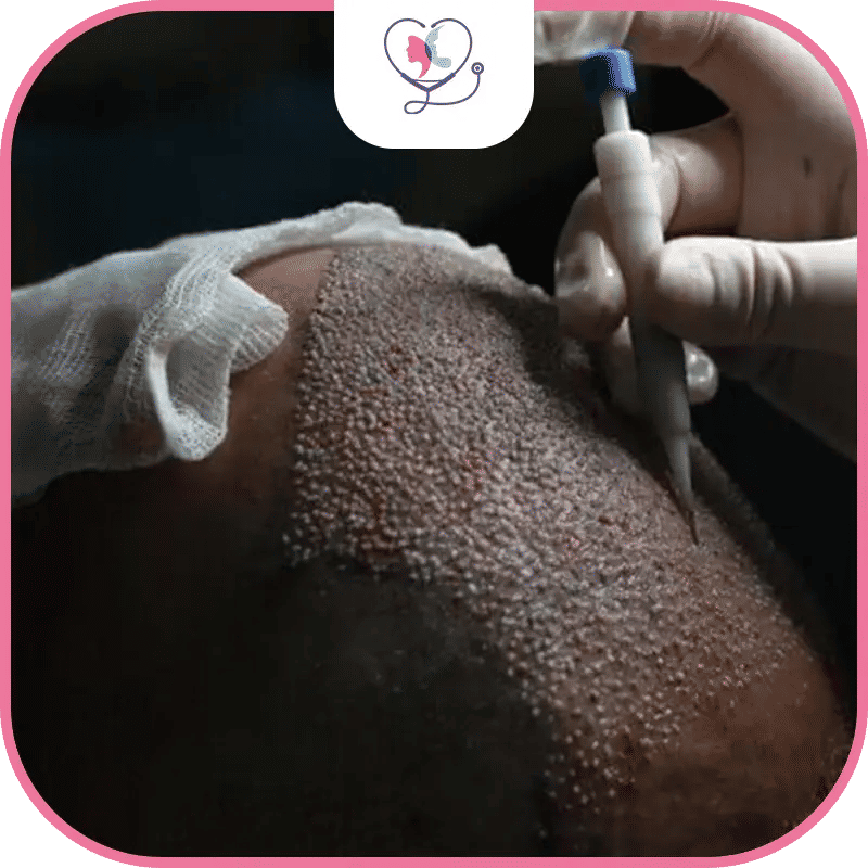 زراعة الشعر DHI في تركيا