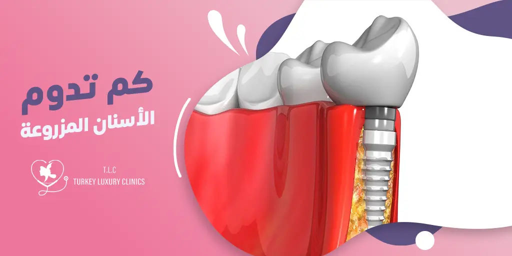 كم تدوم الأسنان المزروعة؟