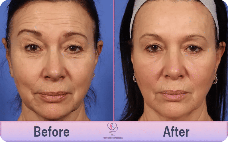 Benefits and Uses of Cosmetic Botox Injection