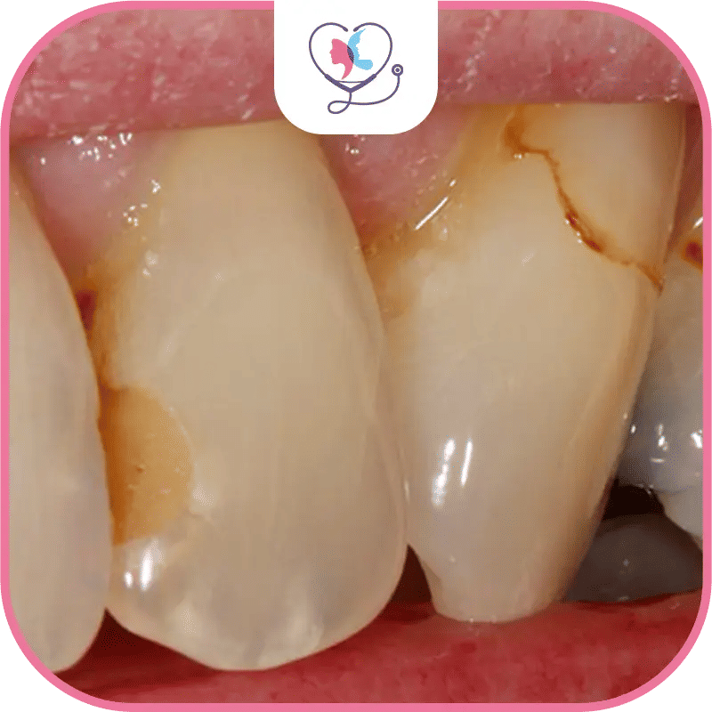 Blanchiment dentaire