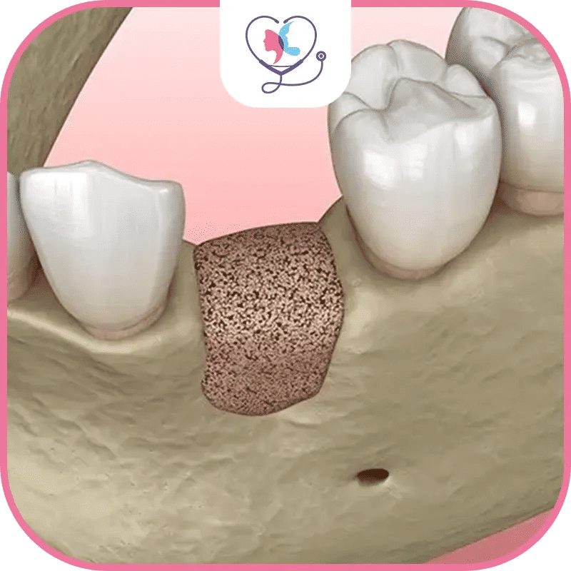 ما هي أسعار زراعة عظم الفك في تركيا؟