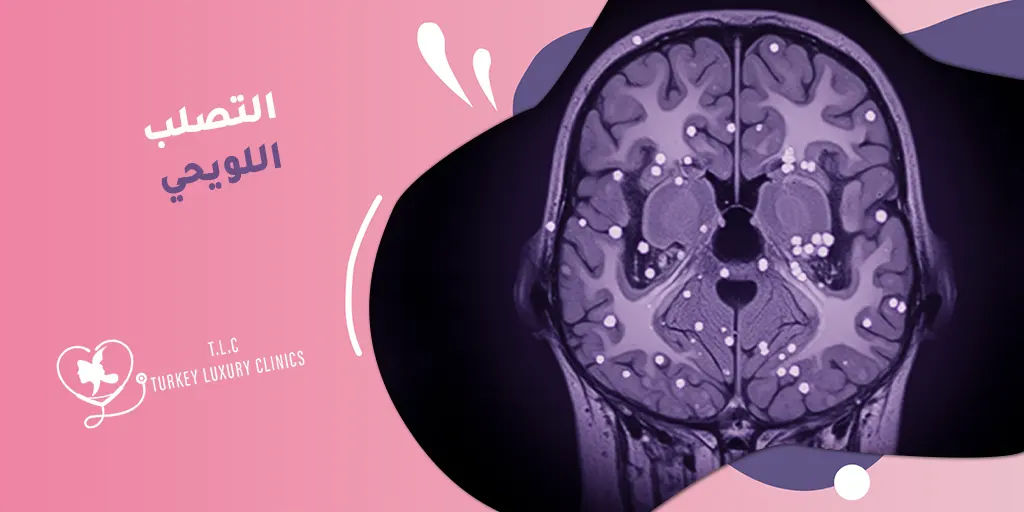 التصلب اللويحي: أعراضه المبكرة وخيارات العلاج الفعالة