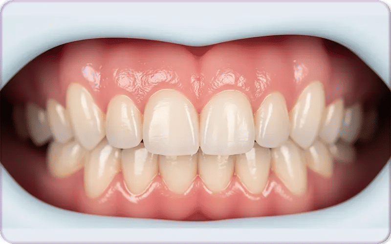 Pourquoi un surfaçage radiculaire est-il indispensable ?