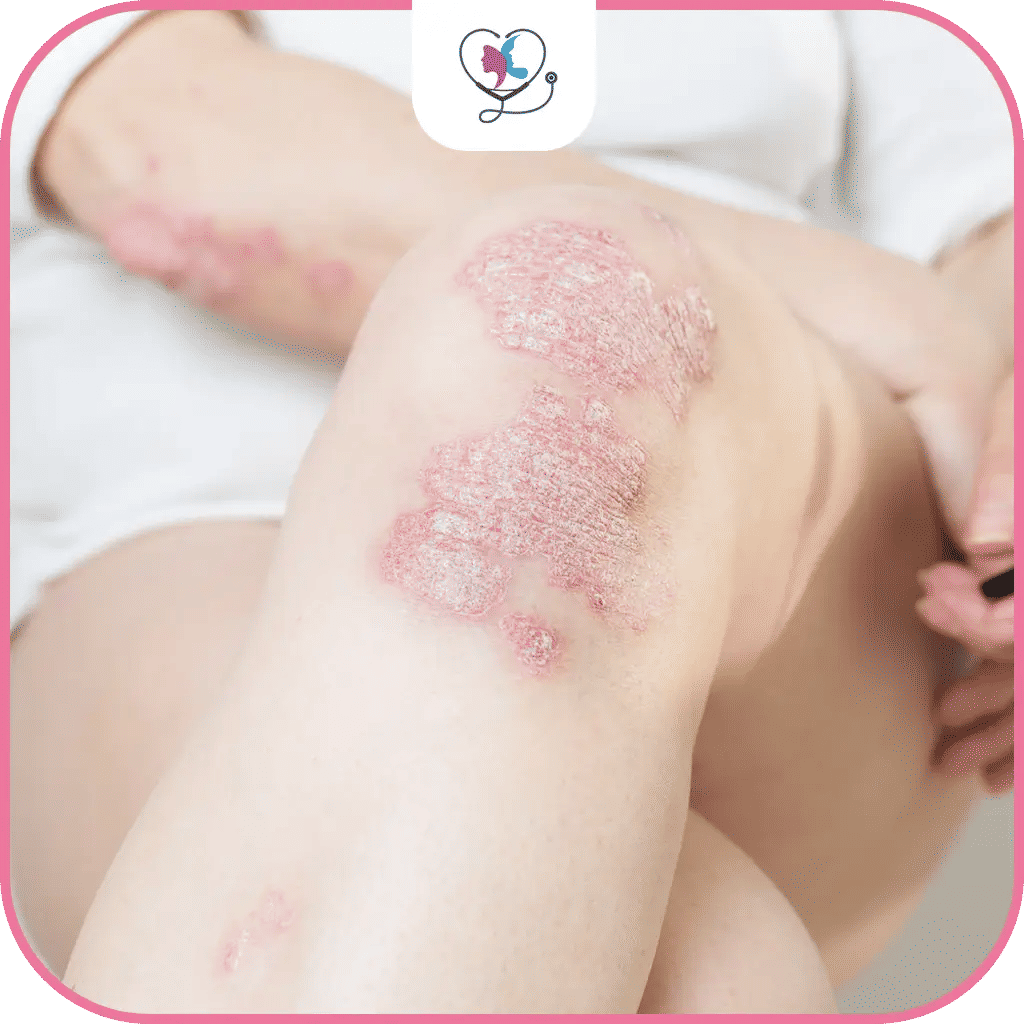 تعريف التهاب المفاصل الصدفي