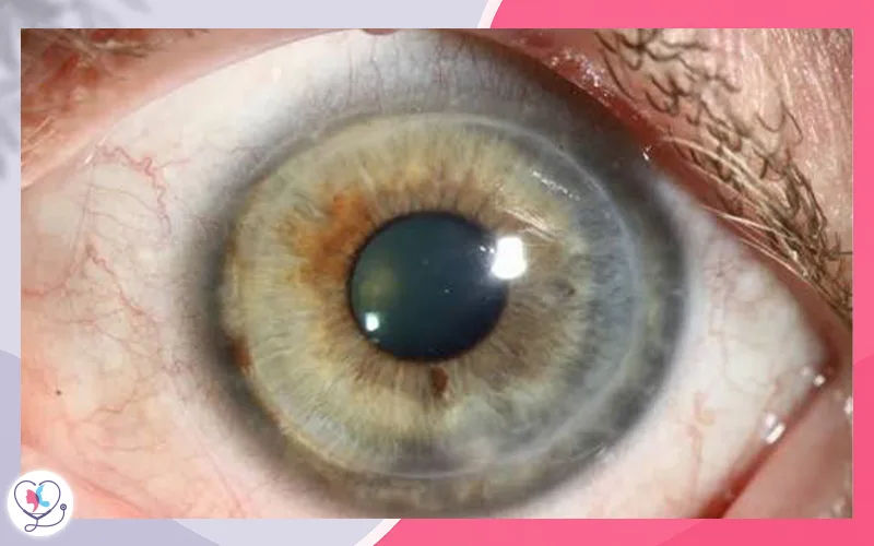  زراعة القرنية الصفيحية الأمامية العميقة (Deep Anterior Lamellar Keratoplasty – DALK)