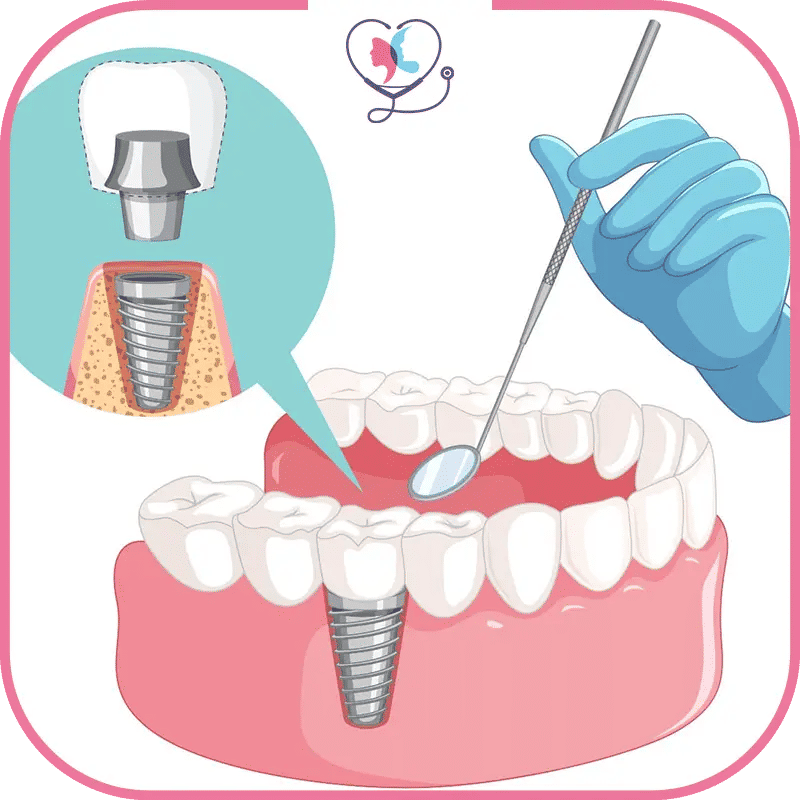 مراحل زراعة الاسنان