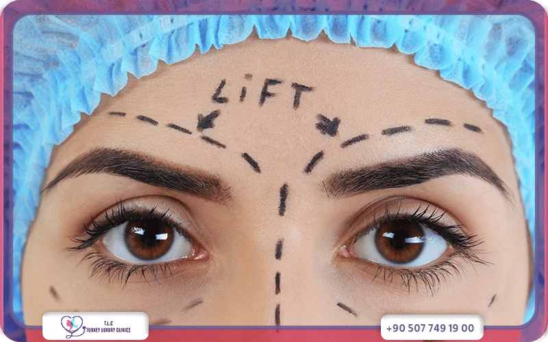 كم تكلفة عملية رفع الحواجب في مختلف الدول؟