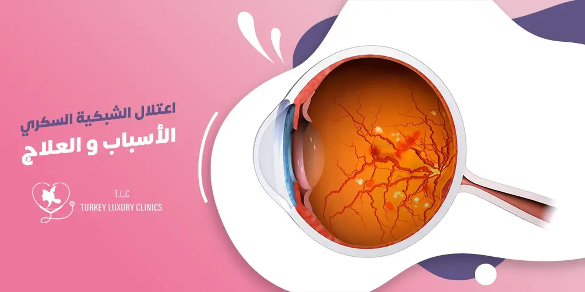 اعتلال الشبكية السكري: الأسباب، الأعراض والعلاج