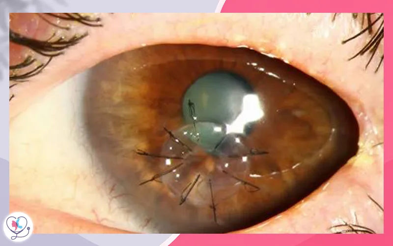  زراعة القرنية الكلية أو النافذة (Penetrating Keratoplasty – PKP)