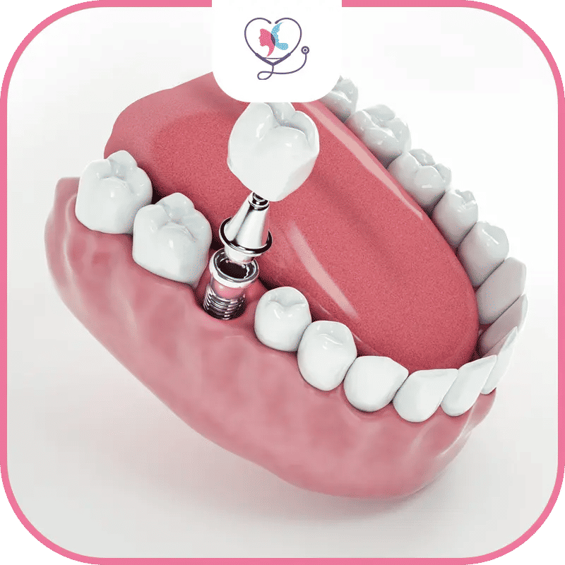 Types of Single Tooth Dental Implants