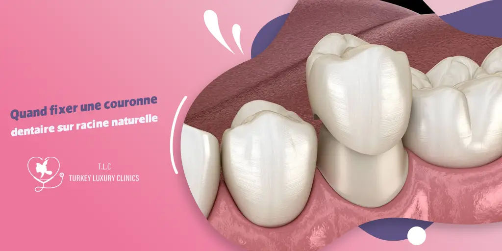 Quand fixer une couronne dentaire sur racine naturelle ?