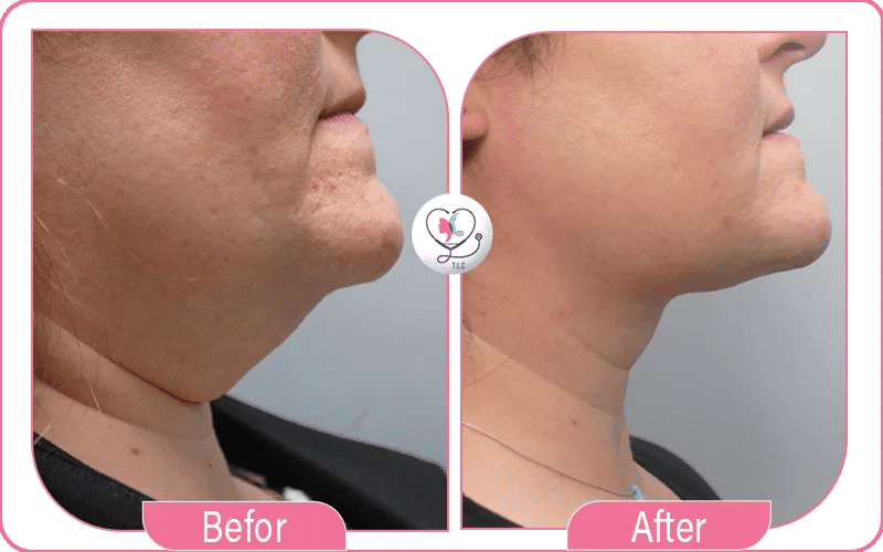 liposuccion douce avant après