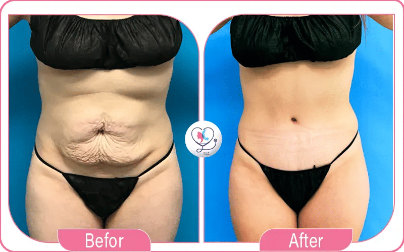 Tummy tuck in Turkey Before and After Photos 3