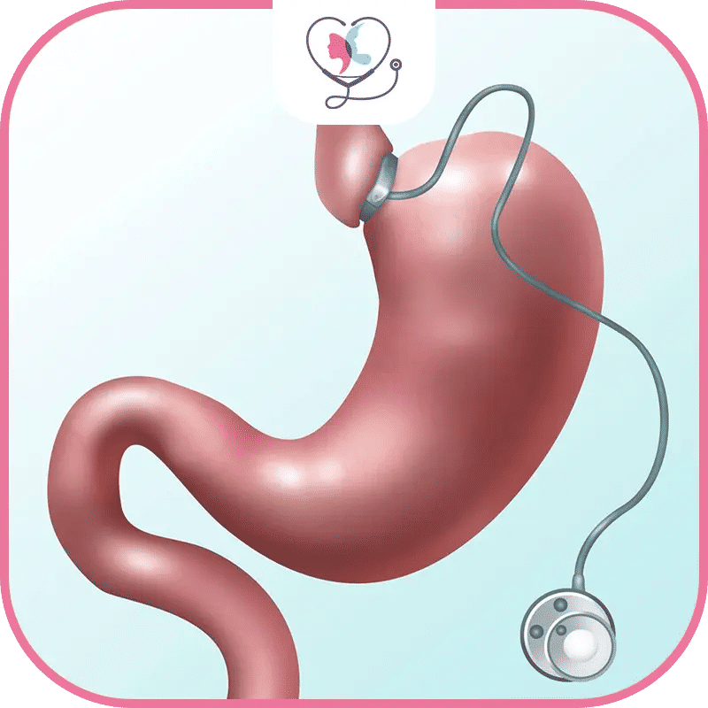 عملية ربط المعدة