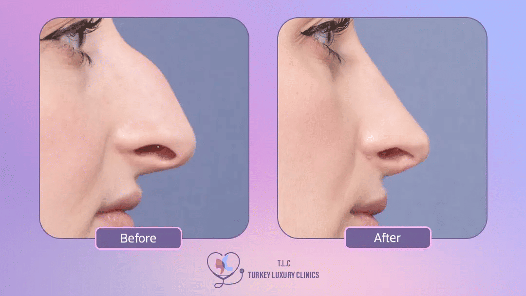 تكلفة عملية تجميل الأنف في تركيا