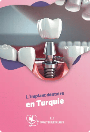 Implant dentaire en Turquie: Guide complet
