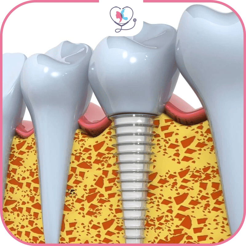 Cost comparison 2025: Understanding the Value Proposition of Dental Implants