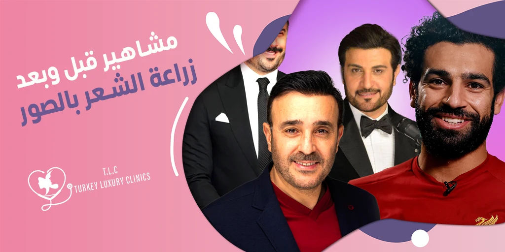 مشاهير قبل وبعد زراعة الشعر بالصور: (عرب وأجانب)