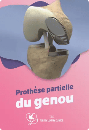 Prothèse partielle du genoufeatured image