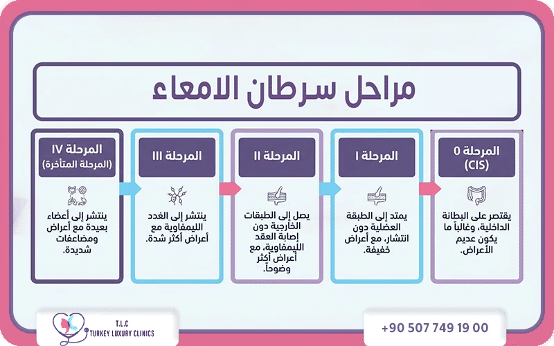 مراحل سرطان الأمعاء مراحل سرطان الأمعاء