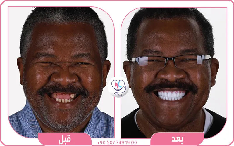 تجربتي مع زراعة الأسنان الفورية في تركيا لاكشري كلينك