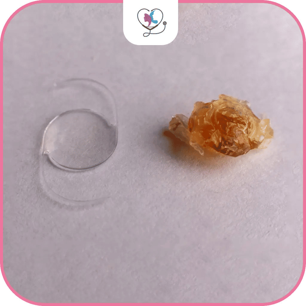 ماهي عملية الفاكو؟