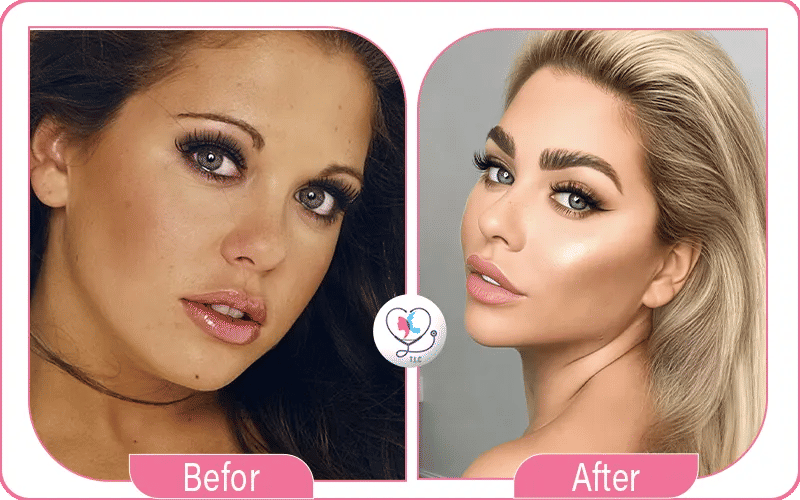 Before and After Eyebrow Transplant Celebrity 4