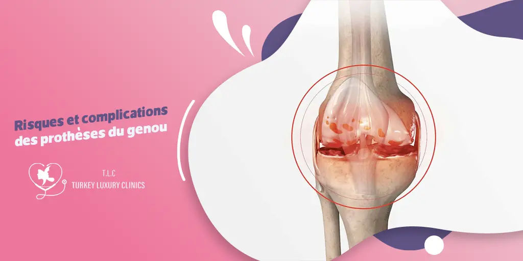 Risques et complications des prothèses du genou